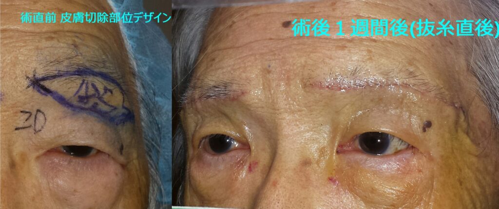 眉下切開眉下リフトデザインと術後7日目